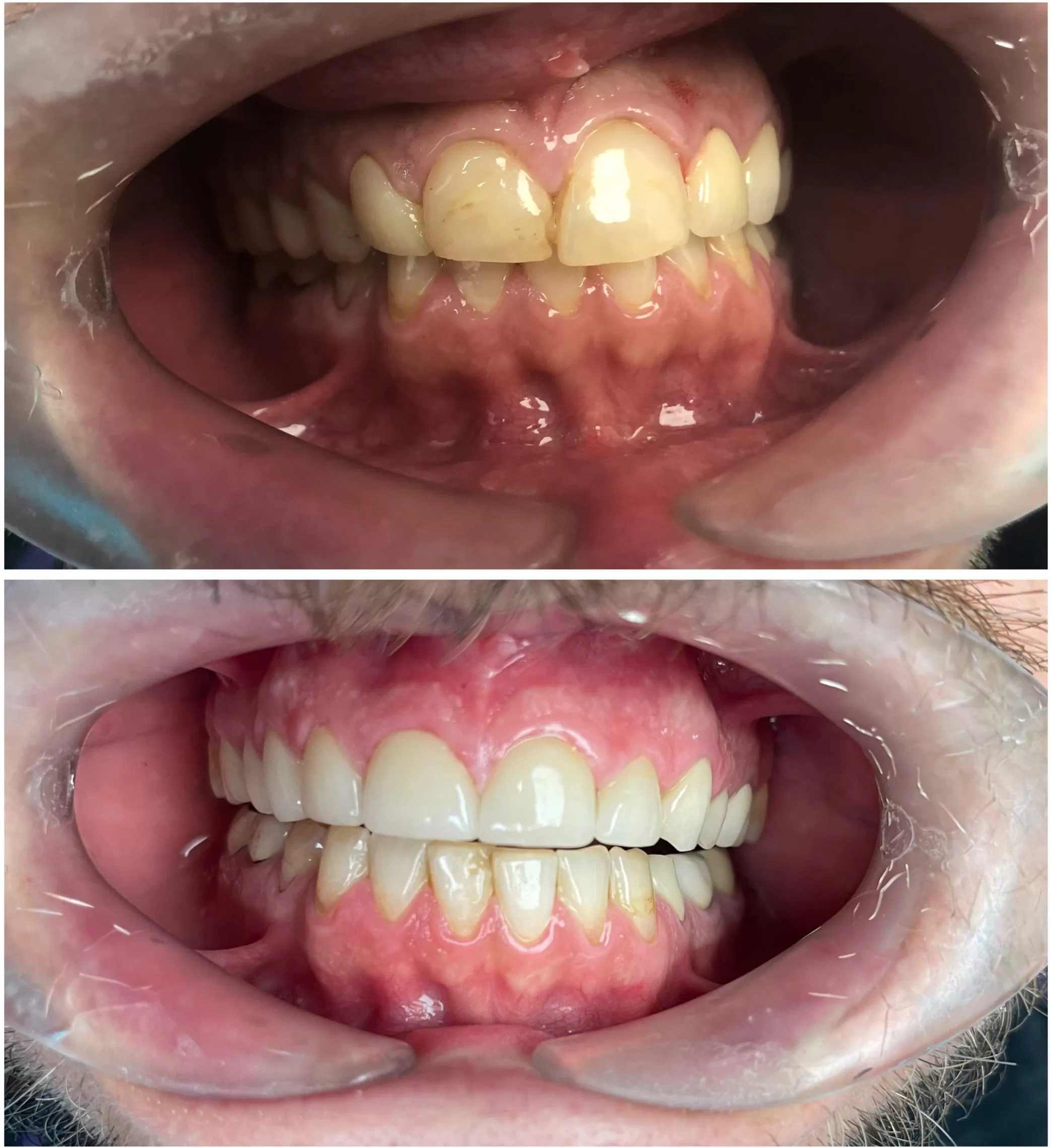 Before and After Teeth client picture