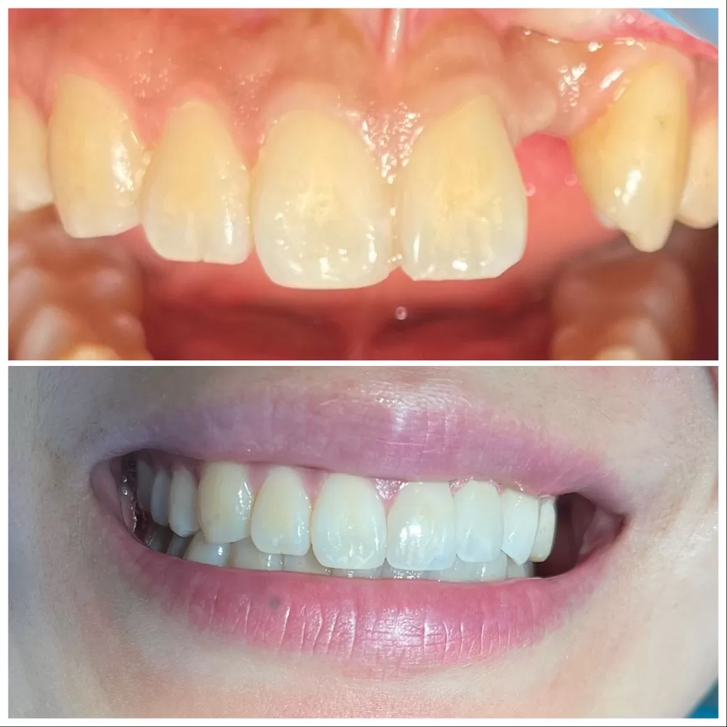 Before and After Teeth client picture