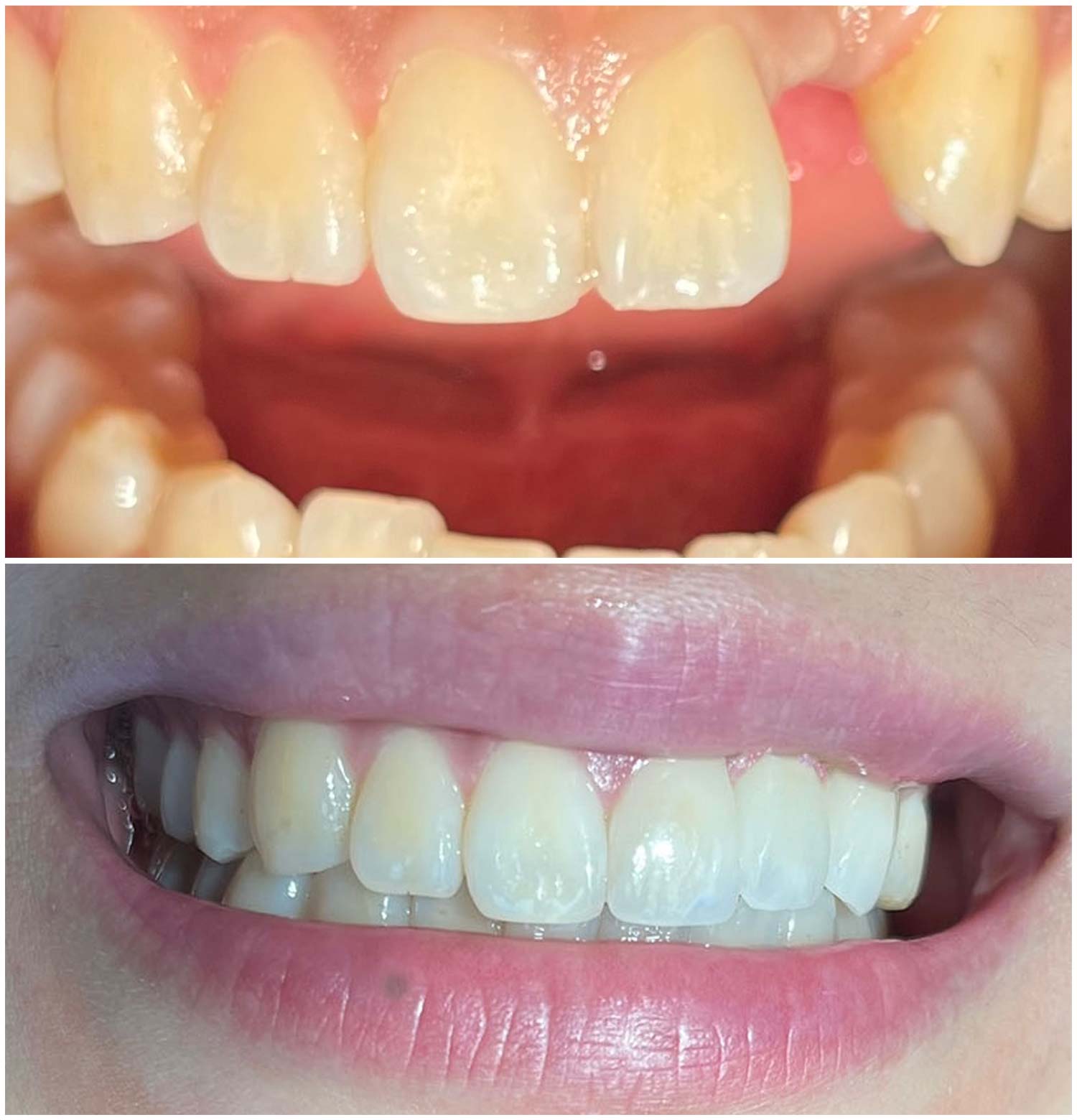 Front Porcelain Bridge