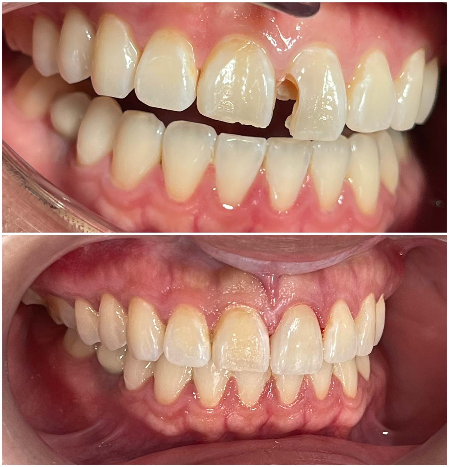 Single Front Porcelain Crown