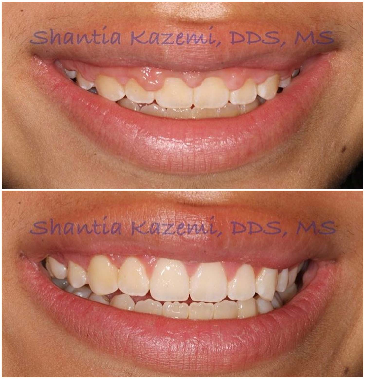 Gingival Contouring