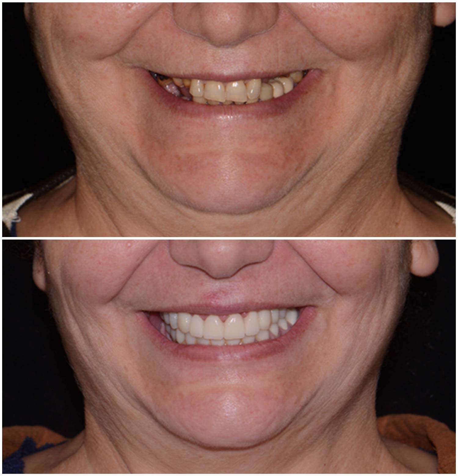 All-on-4 Procedure Before & After Photo