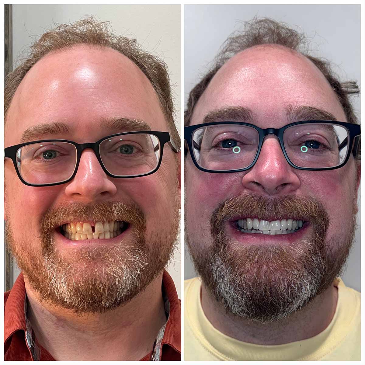 Invisalign Treatment